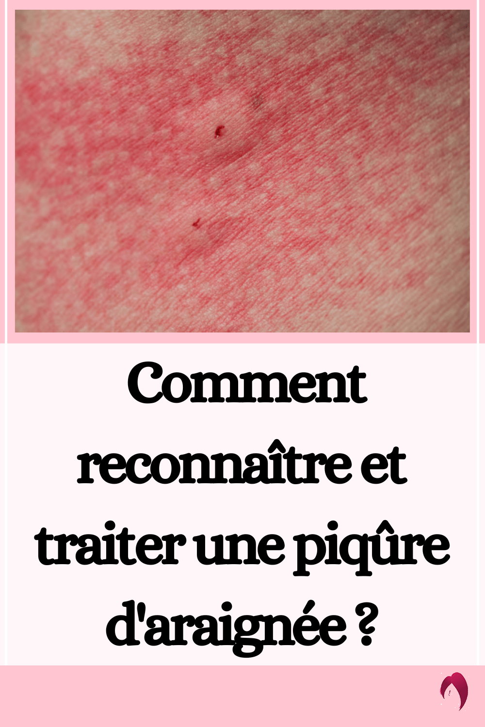 Comment Reconna Tre Et Traiter Une Piq Re D Araign E