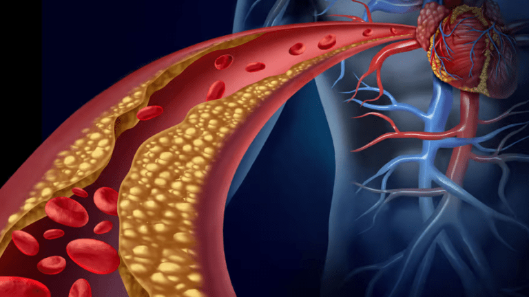 Quelles est la cause d’un Taux élevé de cholestérol ?