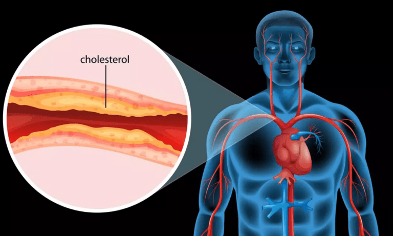 Comment baisser le taux de cholestérol naturellement ?