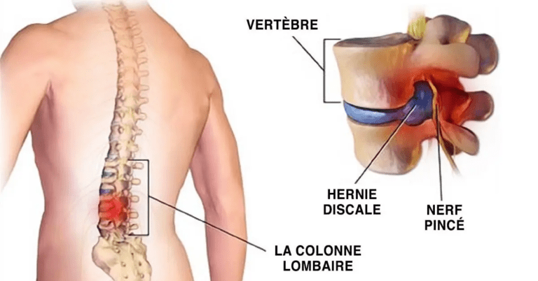 débarrasser des maux de dos