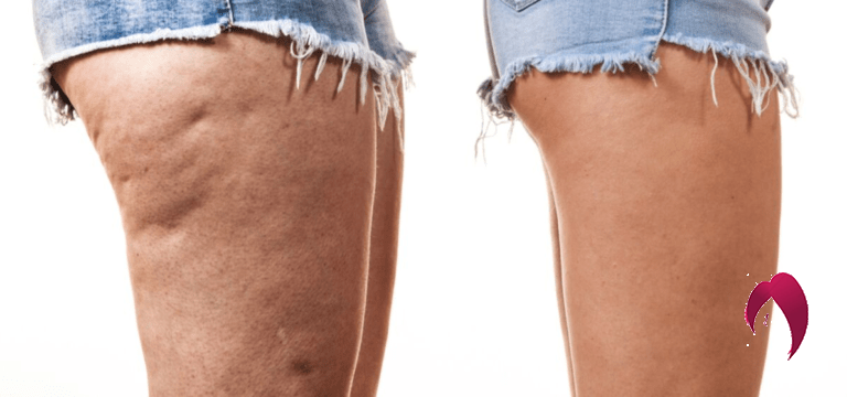 2 Recettes de Grand-Mère pour se débarrasser de la cellulite