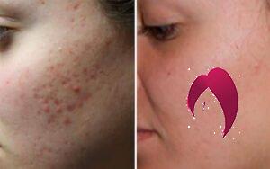 3 remèdes naturels pour lutter contre les cicatrices d’acné