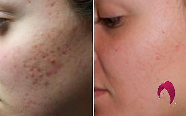 3 remèdes naturels pour lutter contre les cicatrices d’acné