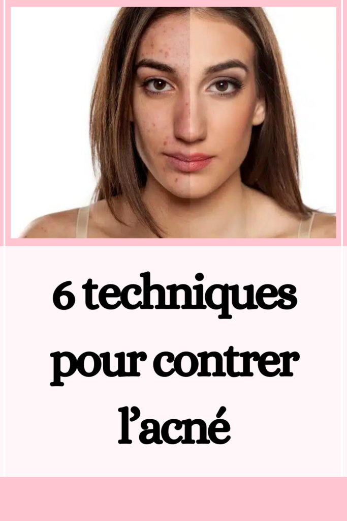 6 techniques pour contrer l’acné