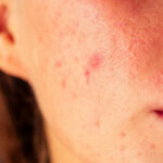 6 techniques pour contrer l’acné