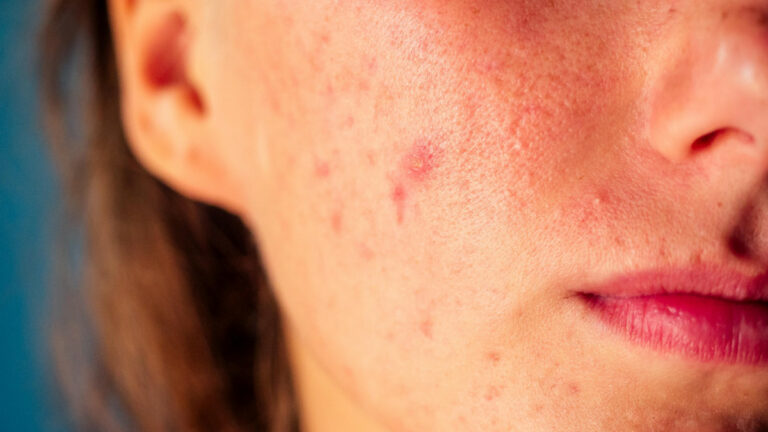 6 techniques pour contrer l’acné