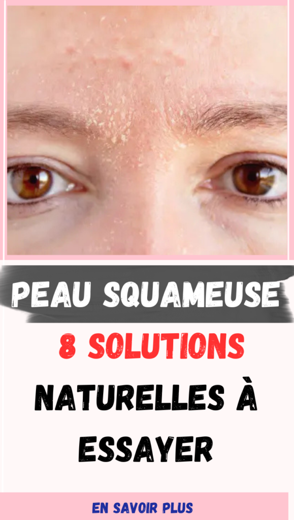 Peau Squameuse